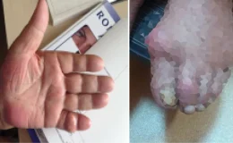 “Kebap diyarının hastalığı” için uyarı! Dayanılmaz ağrılara sebep oluyor, özellikle erkeklerde görülüyor