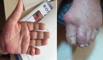 “Kebap diyarının hastalığı” için uyarı! Dayanılmaz ağrılara sebep oluyor, özellikle erkeklerde görülüyor